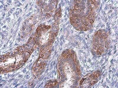 Immunohistochemistry-Paraffin: EGFR [p Tyr998] Antibody [NBP3-13267] - EGFR (phospho Tyr998) antibody detects EGFR (phospho Tyr998) protein at cell membrane in human breast carcinoma by immunohistochemical analysis. Sample: Paraffin-embedded human breast carcinoma. EGFR (phospho Tyr998) antibody (NBP3-13267) diluted at 1:500. Antigen Retrieval: Citrate buffer, pH 6.0, 15 min